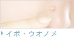 イボウオノメ除去
