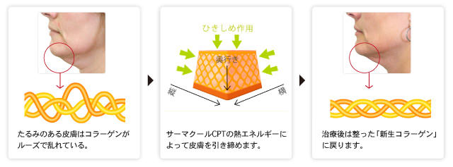 シワとたるみの皮膚構造