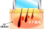 RF脱毛