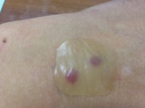 シミ取りレーザー治療で経過観察 かさぶたを取ると痕が残る 札幌シーズクリニック