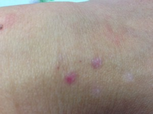 シミ取りレーザー治療で経過観察 かさぶたを取ると痕が残る 札幌シーズクリニック