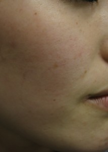 1 SL右頬-治療前
